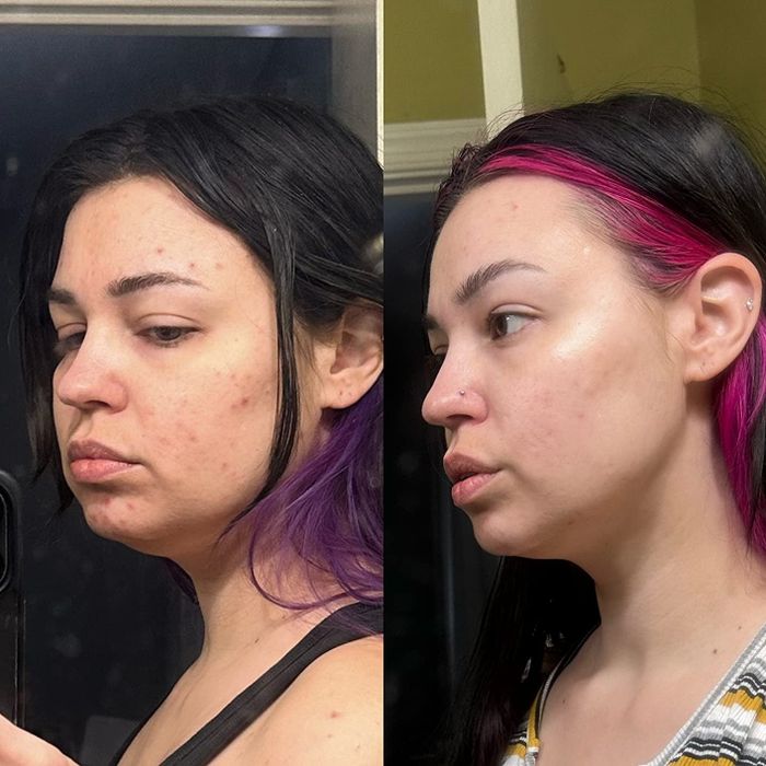 Two close-up images displayed side by side, showing a woman's skincare transformation. On the left: acne and redness. On the right: visibly clearer skin after treatment.