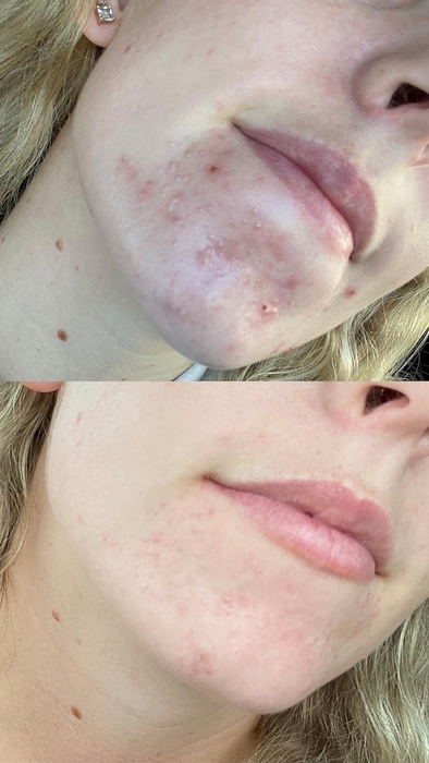 A close-up view of a reviewer's chin and lower face showing before-and-after results of a skincare treatment. The top image shows acne, and the bottom image shows clearer skin after use.