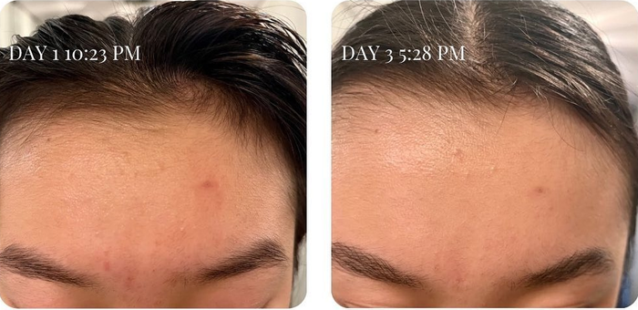 A before-and-after comparison showing the effectiveness of the face wash in clearing up a breakout