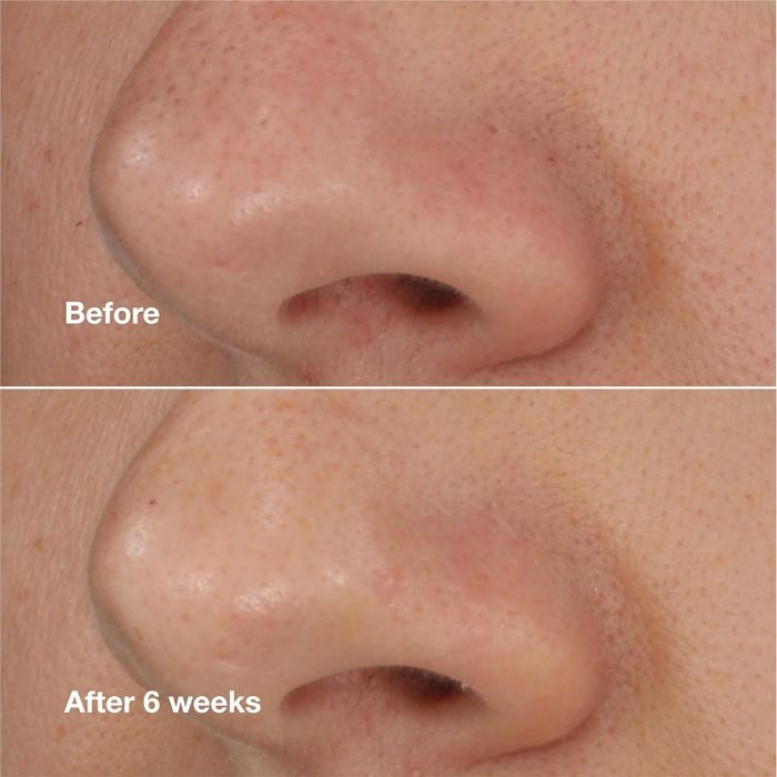 An image split into two, showing a close-up of a nose before and after 6 weeks of skincare treatment, demonstrating improved pore appearance