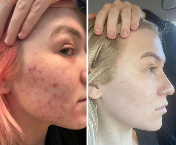 A close-up comparison of a reviewer's cheek, showing acne on the left and clear skin on the right, highlighting the progress made with skincare