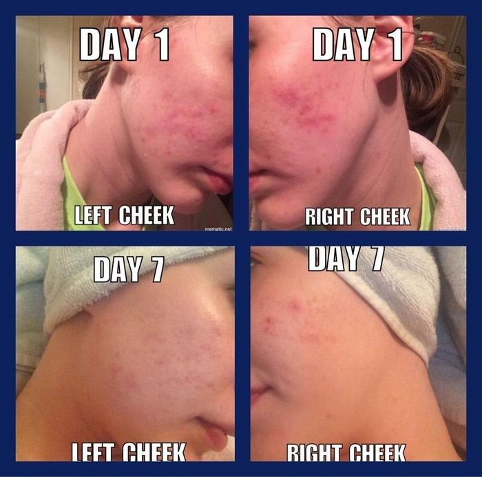 A series of four side-by-side images showing skin improvement on both the left and right cheeks over a 7-day period. The first row is labeled Day 1, and the second row is labeled Day 7.