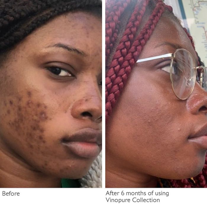 Side-by-side images showing a person's skin improvement after using the Vinopure Collection for 6 months. Left: before treatment, right: after treatment.
