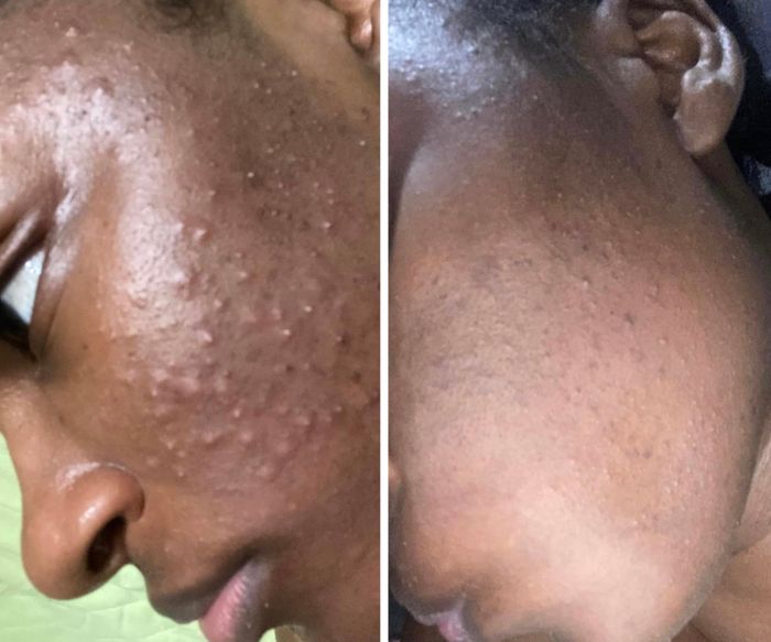 Before-and-after images showing a dramatic improvement in acne reduction on a person's face after skincare treatment.