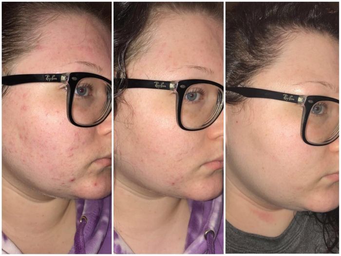 A person wearing Ray-Ban glasses demonstrates an improvement in skin condition through a series of three close-up photos, showcasing a transition from noticeable acne to clearer skin.
