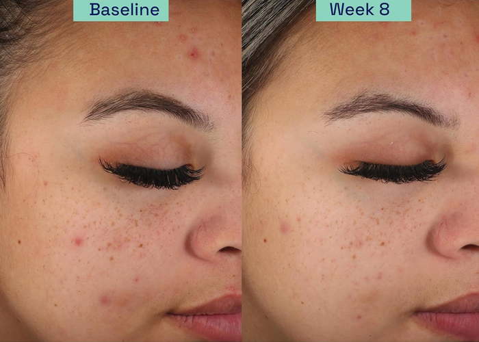 Side-by-side images showing a person's inflamed acne before (Baseline) and after 8 weeks (Week 8) of using the Gentle Clear regimen, with a noticeable reduction in inflammation.