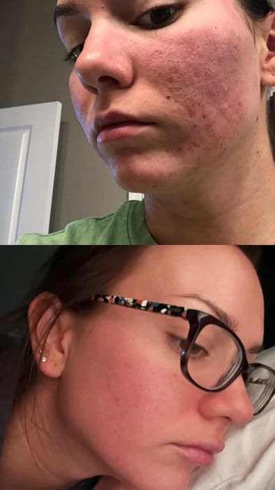 Two close-up images of a reviewer's face, showing a before and after comparison of acne treatment. The top image shows her face with acne, while the bottom image shows clearer skin