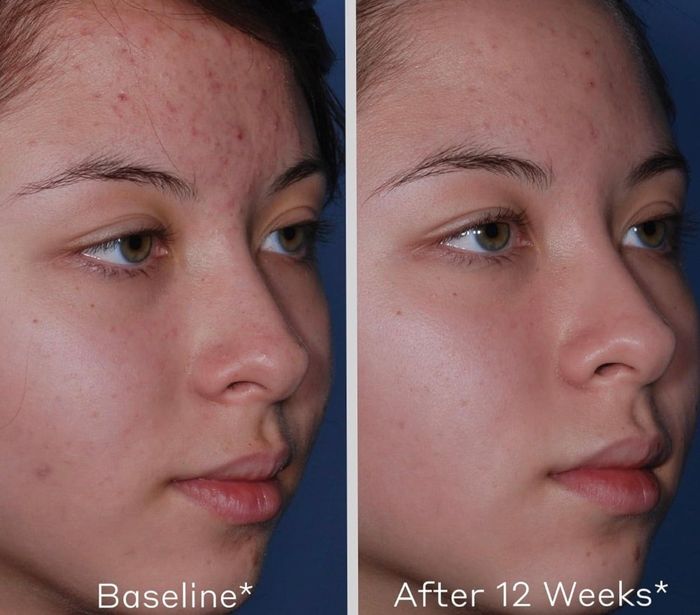 Side-by-side close-up images showcasing the effects of acne treatment. On the left, the person's face before the treatment, with visible acne. On the right, the same person after 12 weeks, revealing clear skin