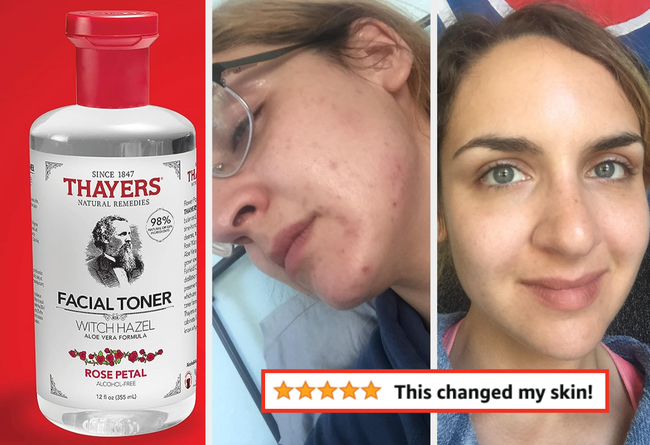Thayers Facial Toner bottle featuring a skin transformation before and after image; accompanied by a 5-star customer review