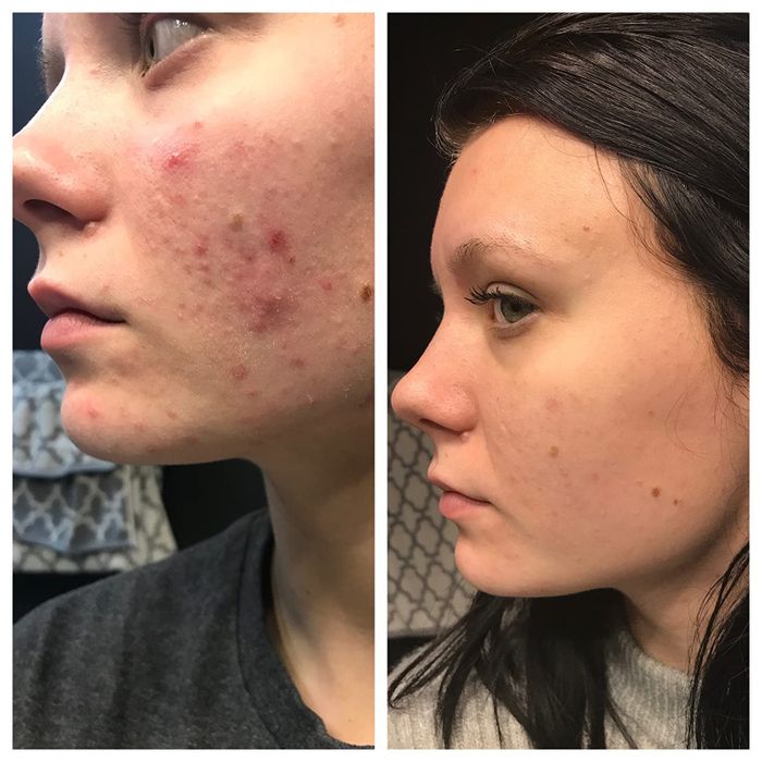 A reviewer's before-and-after photo showing her skin noticeably clearer and brighter.