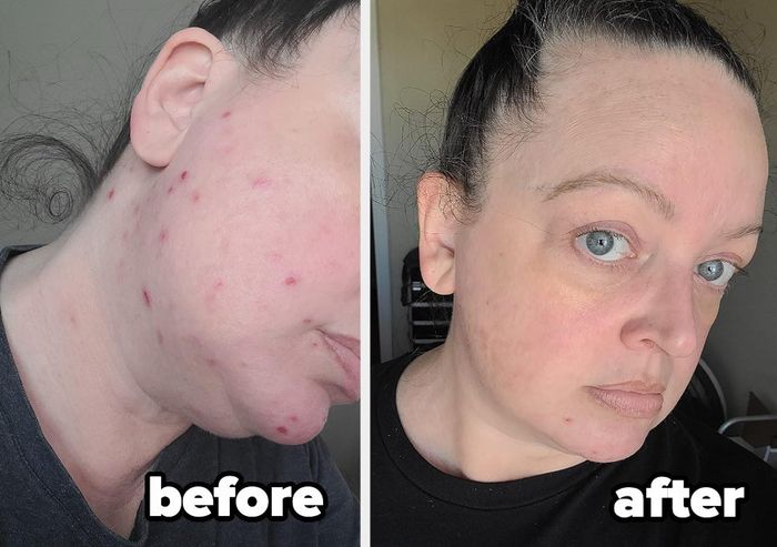 A reviewer's before and after images demonstrating the reduction of their acne after using the wipes