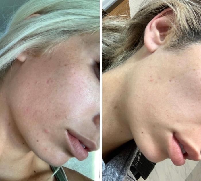 Close-up images showing a person's cheek before and after skincare treatment, demonstrating improved skin texture and the reduction of blemishes.