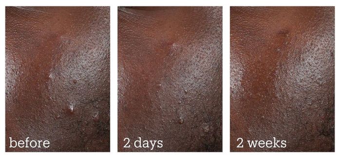 Close-up images comparing skin before and after acne treatment, showing noticeable improvement