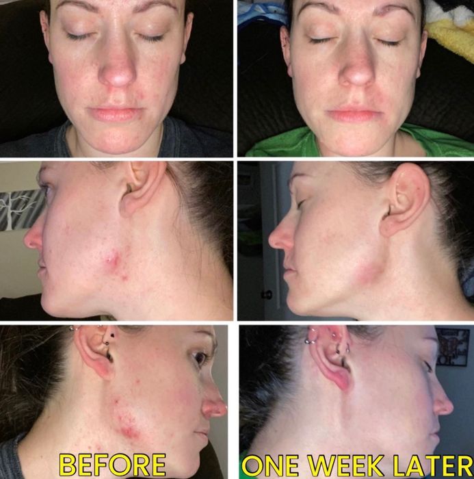 A woman shows her face before and one week after using a skincare product, highlighting significant improvement in acne and skin texture. Text: