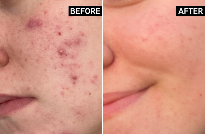 Before and after close-up of a model's cheek, showing the results of acne treatment and the improvement in skin clarity.