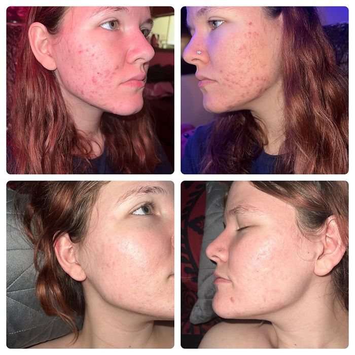 Four photos of a person named Kim showing the before and after results of acne treatment on her face.