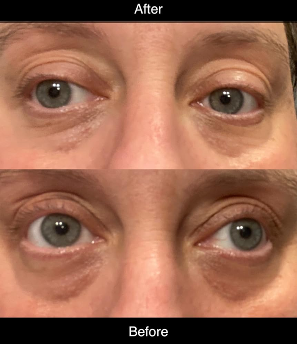 A before-and-after comparison from another reviewer showing a significant reduction in dark circles after using the under-eye patches