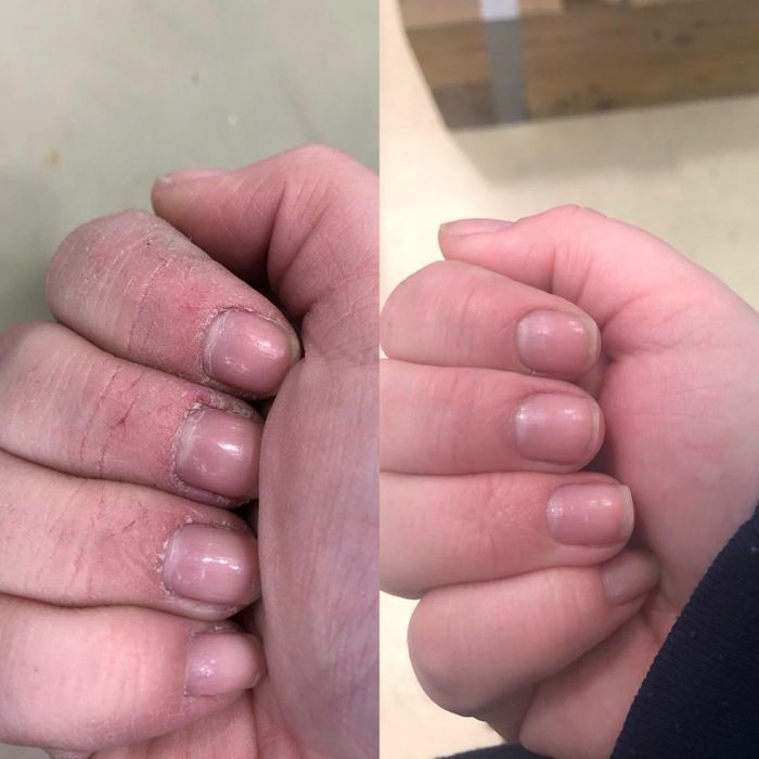 Another reviewer's before-and-after showing their dry, cracked hand before using the cream and soft, hydrated hand a week later.