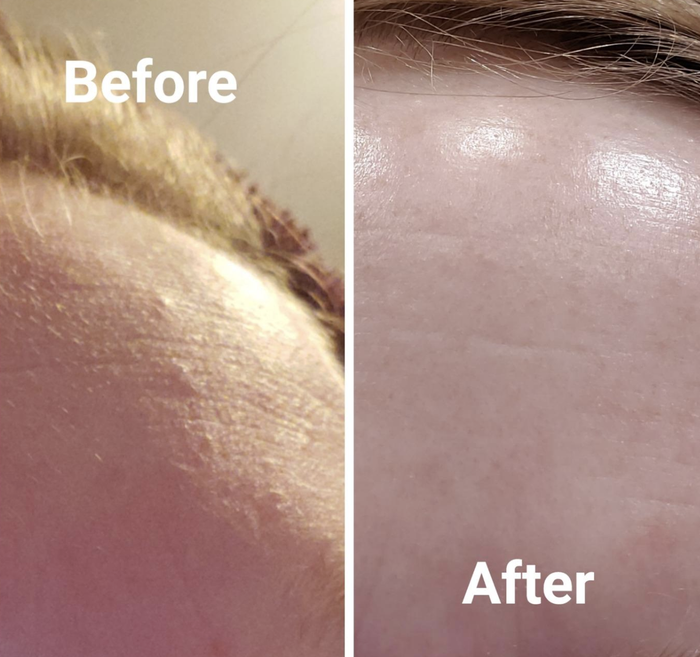 Reviewer before and after photo showing fine lines and pimples on the left, and visibly reduced fine lines and breakouts on the right
