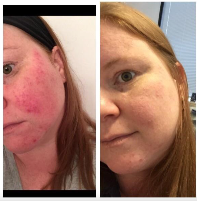 Reviewer demonstrates how the spray helped reduce their rosacea symptoms