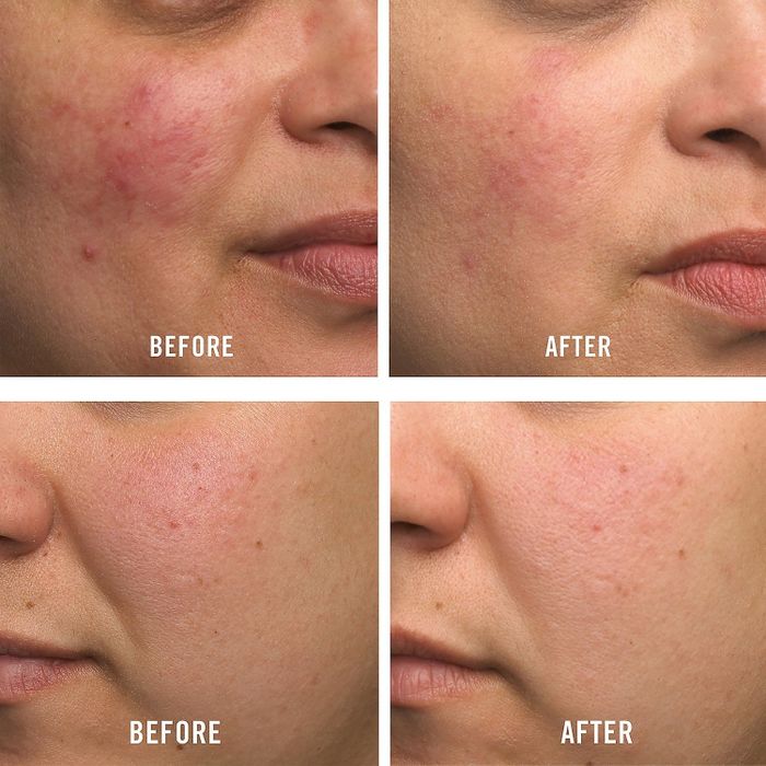 Reviewers showing blemished, inflamed skin before using the product, and clearer, calmer skin after applying the cream