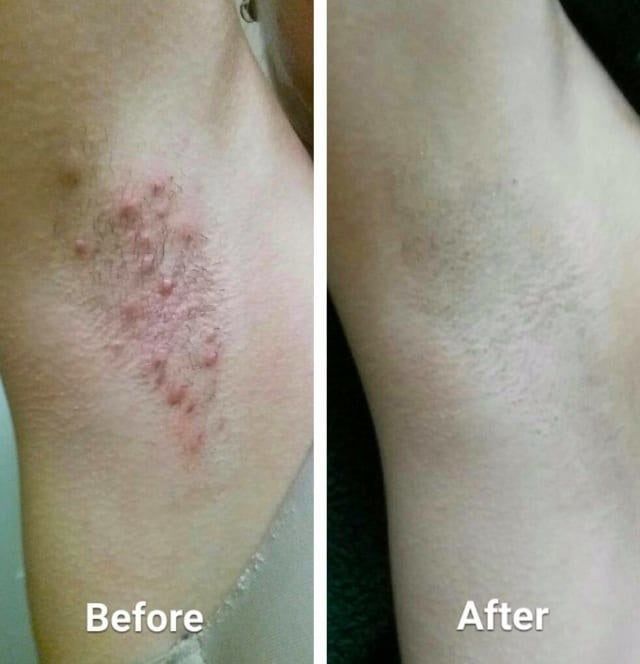 Before and after photo of reviewer’s armpits, showing significant razor burn and bumps in the first image. The second image reveals smooth, irritation-free skin.