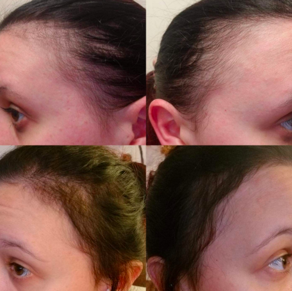 a series of four images showcasing the gradual regrowth of a reviewer's hair