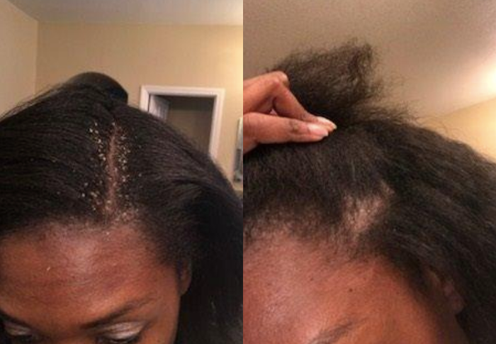 before: hair visibly affected by dandruff; after: hair nearly free of dandruff