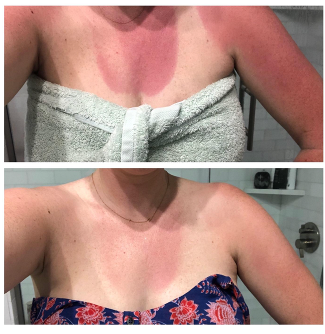 reviewer showing chest before using lotion where sunburn is visible, and after applying it four times over 24 hours, the burn has significantly improved