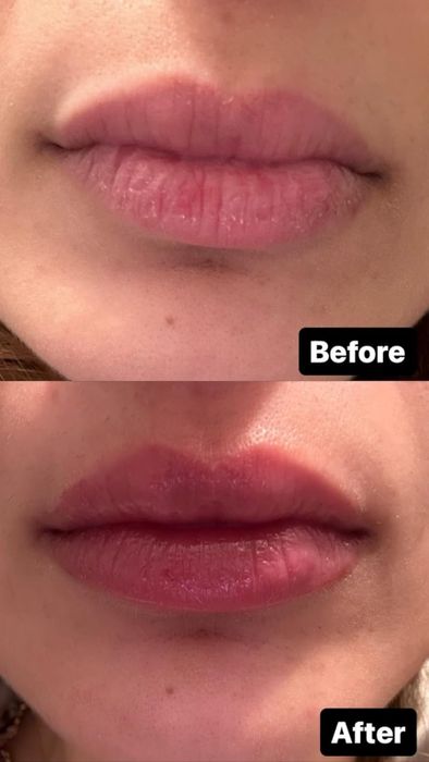 A close-up of a reviewer’s lips, showing a before-and-after comparison of a lip-enhancing product. The top image shows thinner lips, while the bottom image displays fuller, more defined lips.
