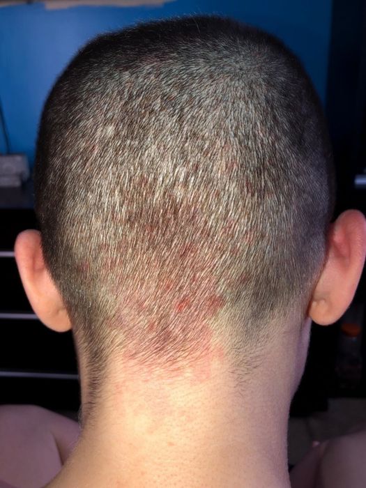 reviewer's before photo showing significant scalp irritation