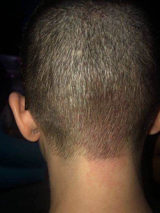 same reviewer's after photo with virtually no scalp irritation