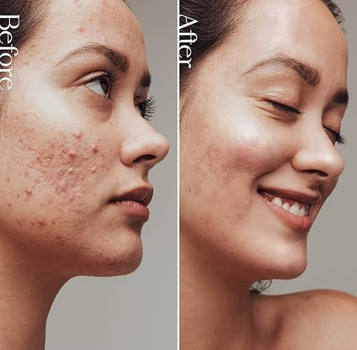 A direct comparison: before shows acne on a woman's cheek, after reveals smooth, clear skin.