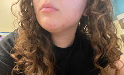 Same reviewer now with clear, smooth skin.