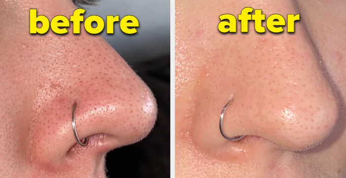Before-and-after comparison of a reviewer's nose showing blackheads, followed by a clear complexion.