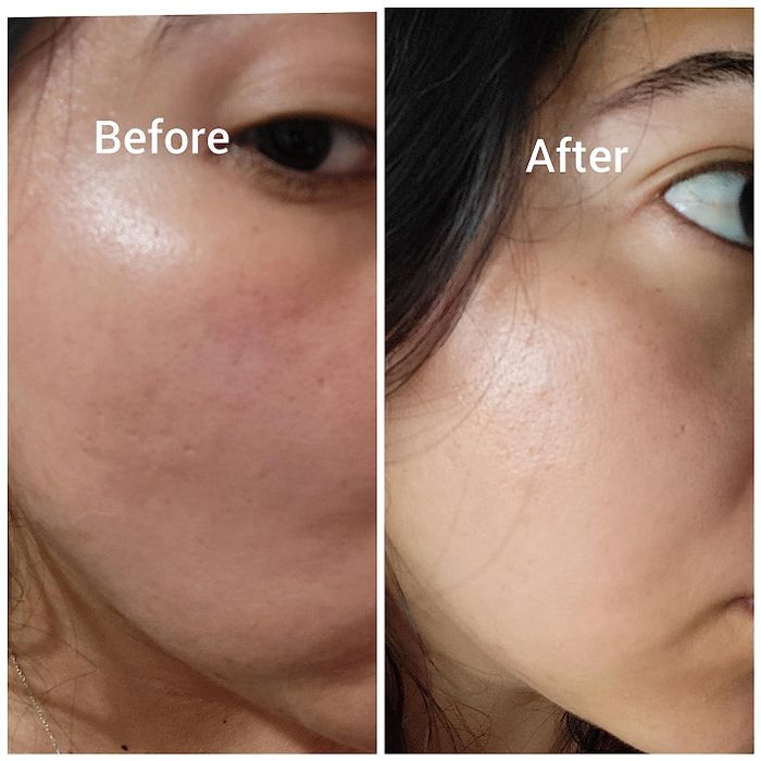 A close-up comparison of someone's skin before and after using the skincare treatment.
