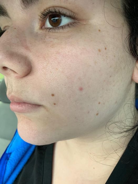 A reviewer's after photo showing nearly clear skin.