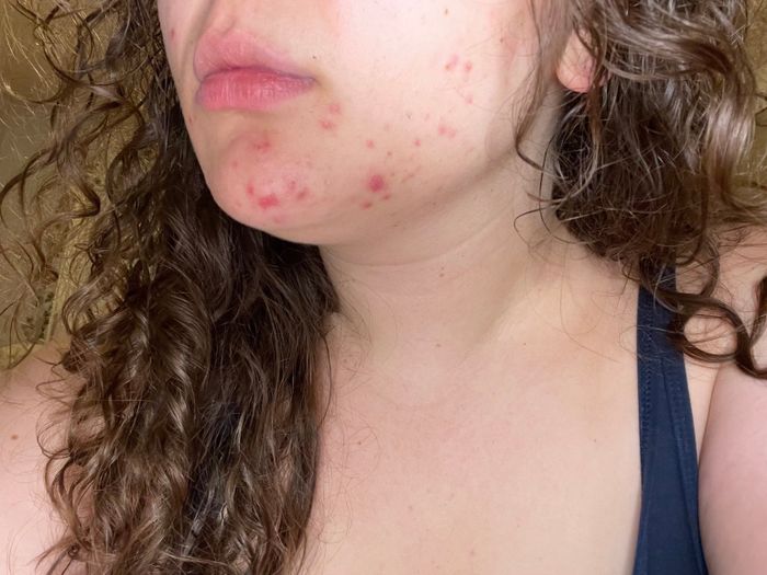 Close-up shot of a person's lower face with noticeable acne.
