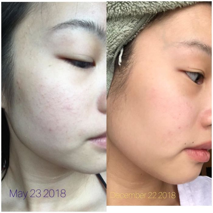A reviewer's before-and-after showing how the serum cleared up red, irritated bumps on their cheek.