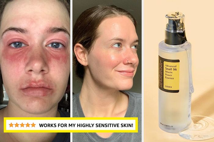 Before-and-after shots of someone with skin irritation; a bottle of snail mucin essence