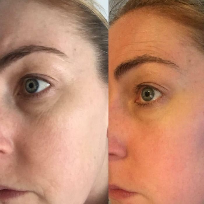 A before and after image showing the transformation of a person’s under-eye area