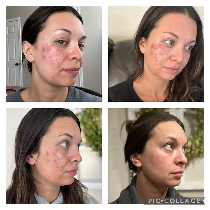 A collage showcasing the evolution of a person's facial skin condition over time.
