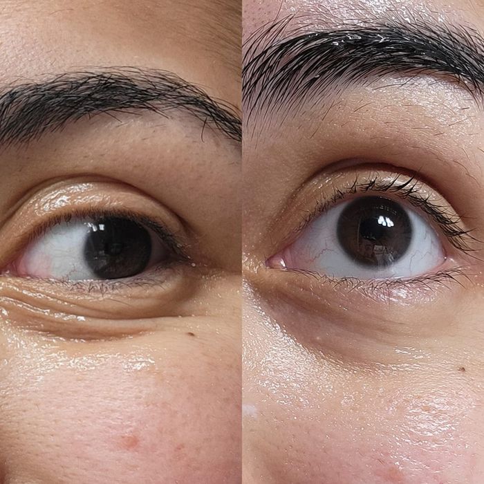 Before-and-after image showing an eye with visible fine lines, followed by a smoother, less lined eye.