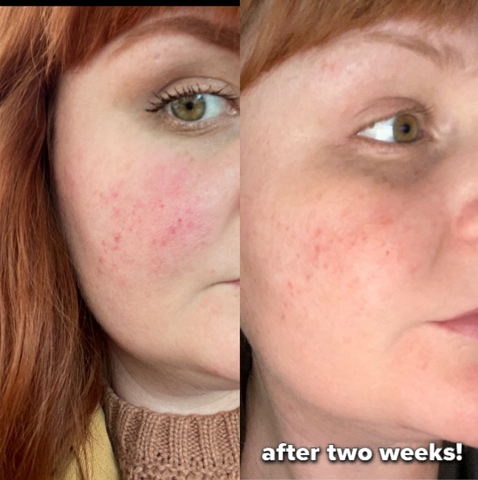 A reviewer's before-and-after photo showing a noticeable reduction in redness, with an added caption highlighting the change.