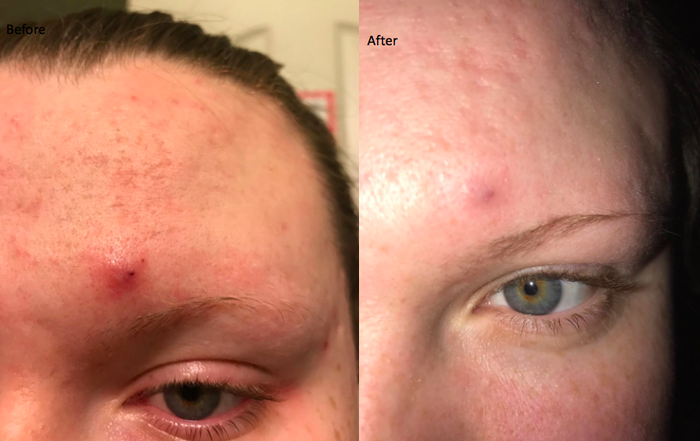A reviewer shows an angry pimple on their forehead, then follows with a picture of the same area visibly flattened and healing