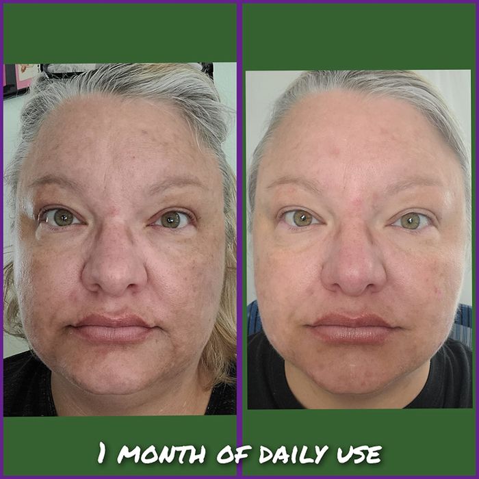 A reviewer shows their skin after one month of using the serum, with scars visibly faded, highlighting the product's effectiveness.
