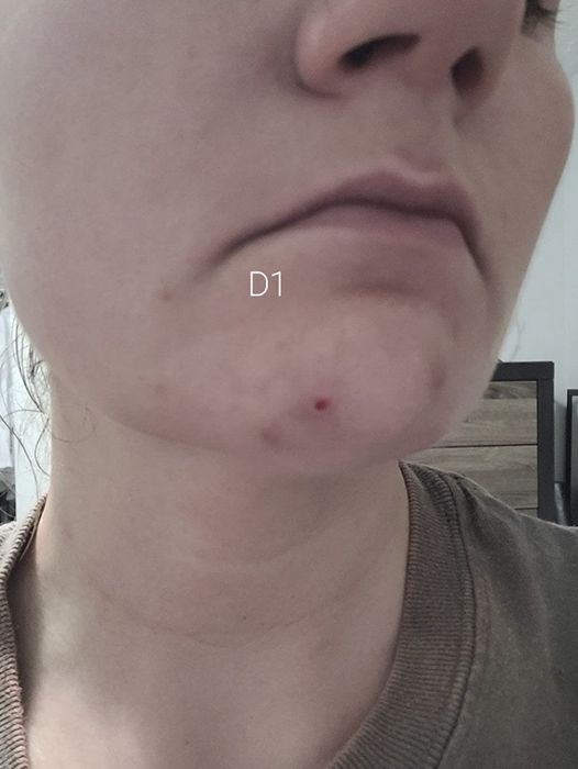The second day of an acne scar