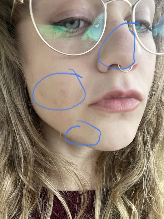 A reviewer's skin condition before using the rosehip oil.