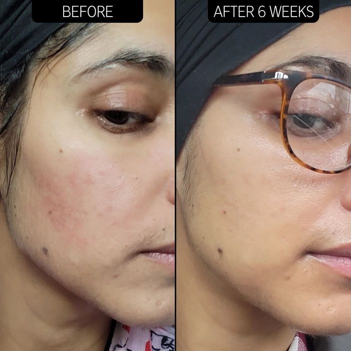 A model showing redness on the cheek followed by the same model with visibly soothed skin after six weeks of use.