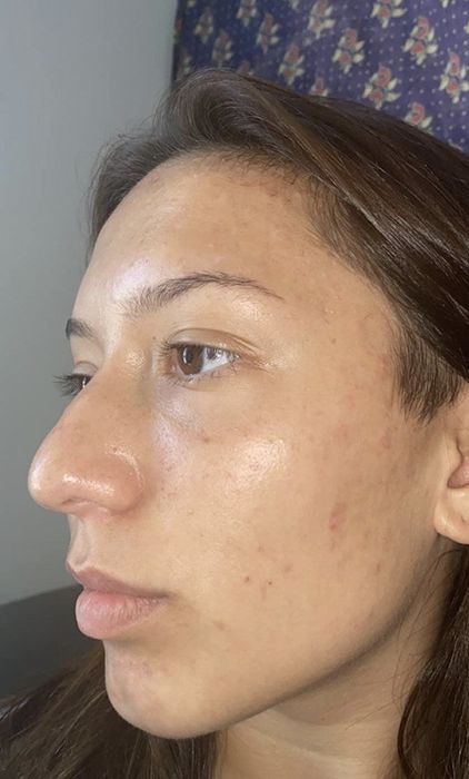A person with visibly clearer skin after using the cleanser.